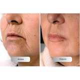 SkinLift™ Sérum Facial Botox